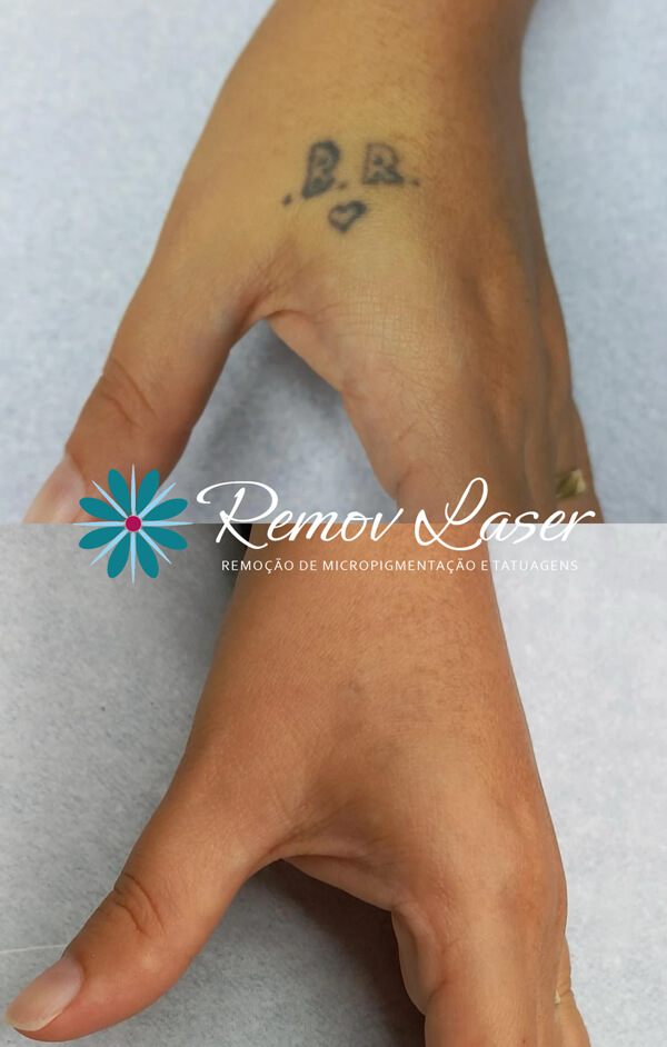 REMOV-004