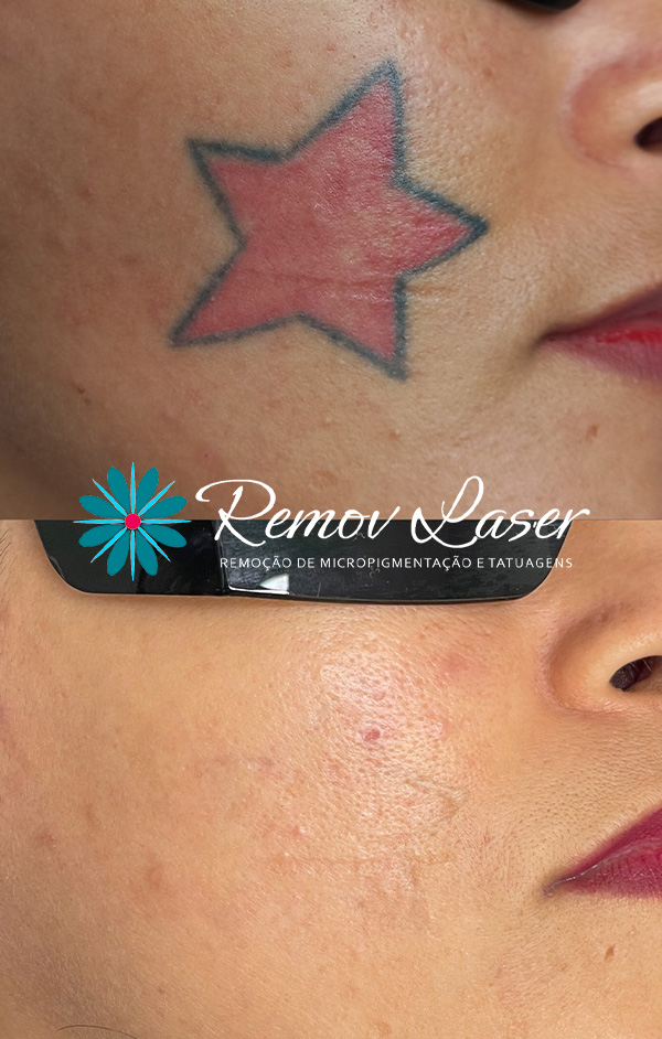 REM-TATUAGEM-02-1